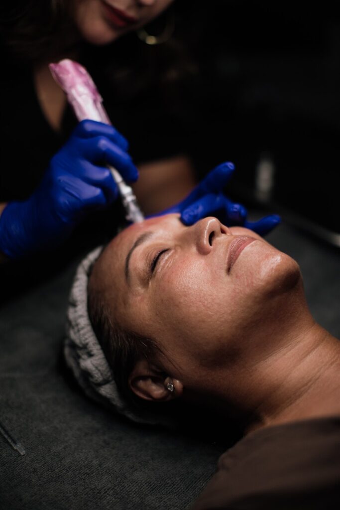 Micro-needling with LOMA