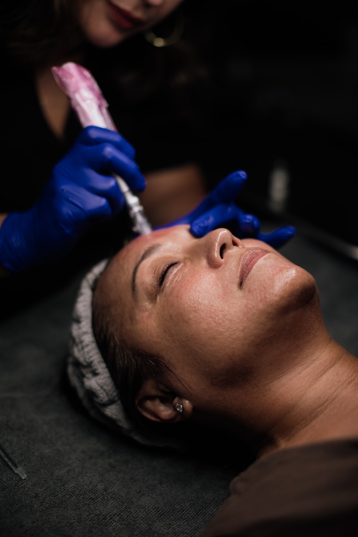 Micro-needling with LOMA